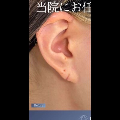 耳垂裂修正も当院にお任せください👏🏻の症例写真[ビフォー]