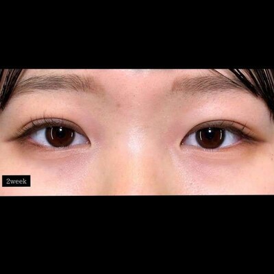 二重埋没法でパッチリ可愛いお目元へ❣️の症例写真[アフター]