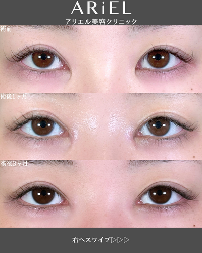 目頭切開の症例写真