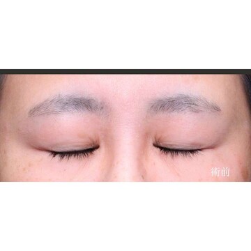 聖心美容クリニックの二重の症例写真[ビフォー]