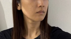ペルラクリニック神宮前のリフトアップの症例写真[ビフォー]