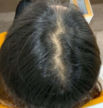 リアスクリニック 銀座院の薄毛治療の症例写真[ビフォー]