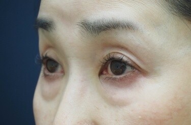 下まぶたのたるみ⼿術（表ハムラ法）の症例写真[ビフォー]