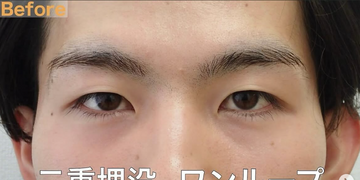 さかえ皮フ科クリニック（旧：ニドークリニック名古屋）の目・二重整形の症例写真[ビフォー]