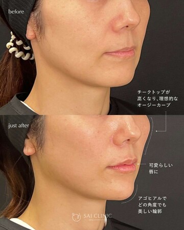 SAI CLINIC （サイクリニック）のリフトアップの症例写真