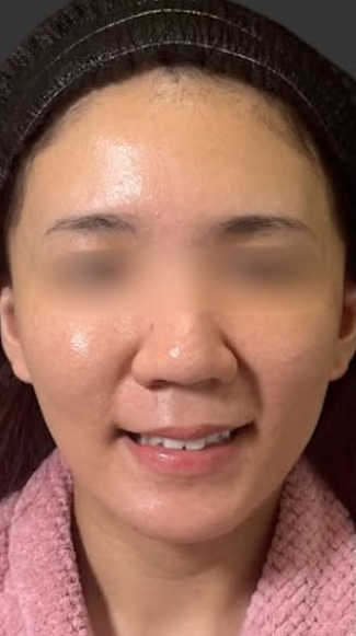 Plume Clinicの脂肪吸引の症例写真[ビフォー]