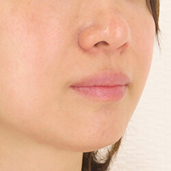 ほうれい線のしわ 成長因子グロースファクター注射 40代 ほうれい線の整形の症例 A Clinic エークリニック Cs 美容医療の口コミ広場