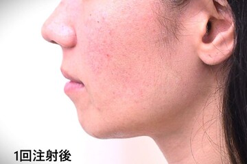 医療法人秀晄会 心斎橋コムロ美容外科クリニックの症例写真[アフター]