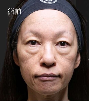 聖心美容クリニックの目元の症例写真[ビフォー]