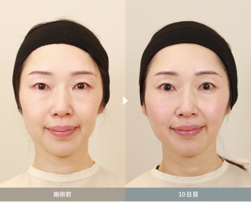 SAI CLINIC （サイクリニック）のリフトアップの症例写真