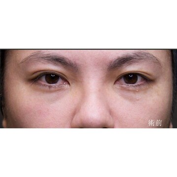 聖心美容クリニックの目元の症例写真[ビフォー]