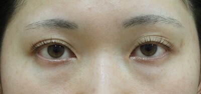 ⽬の下のクマ取り（結膜側脱脂術）の症例写真