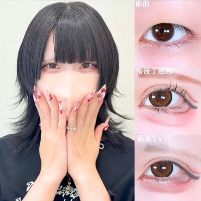 アリエルフォーエバークロス二重埋没法の症例写真