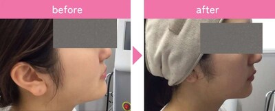 サーマジェンの症例写真
