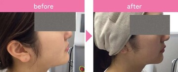 タイムルクリニックの輪郭・顎・エラ・額・小顔整形の症例写真
