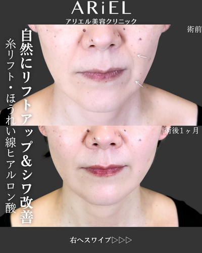 糸リフト/ほうれい線ヒアルロン酸の症例写真
