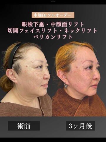 CHARIS BEAUTY CLINICのしわ・たるみ整形(注入、糸、フェイスリフト)の症例写真