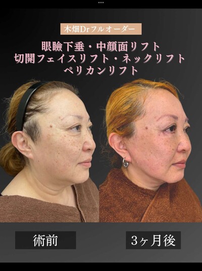 切開フェイスリフト・ネックリフト・ペリカンリフトの症例写真