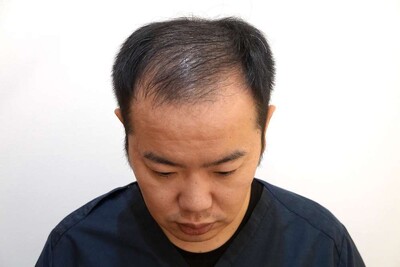 Rebirth+ミノキジェット｜40代｜12か月の症例写真[ビフォー]