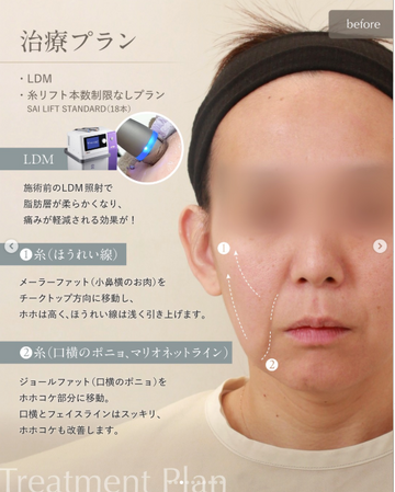 SAI CLINIC （サイクリニック）のリフトアップの症例写真