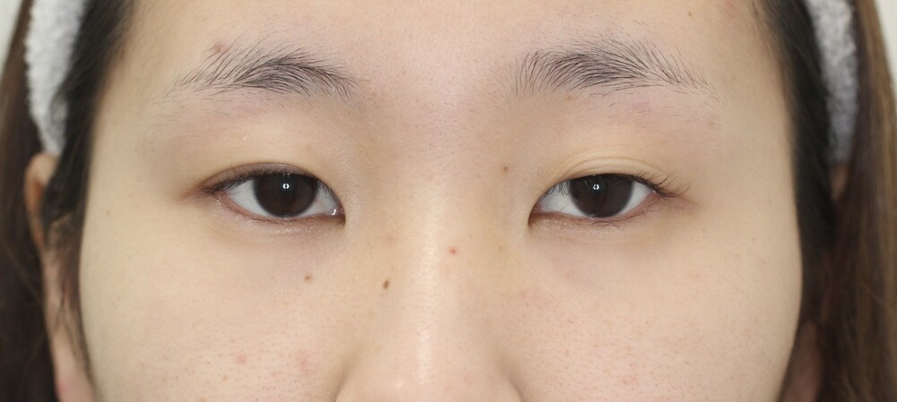 眼瞼下垂症【保険適応】（目・二重整形）の症例写真 (CS65335)｜U CLINIC SHINJUKU （ユークリニック新宿）《美容医療の