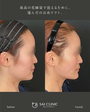 SAI CLINIC （サイクリニック）のリフトアップの症例写真