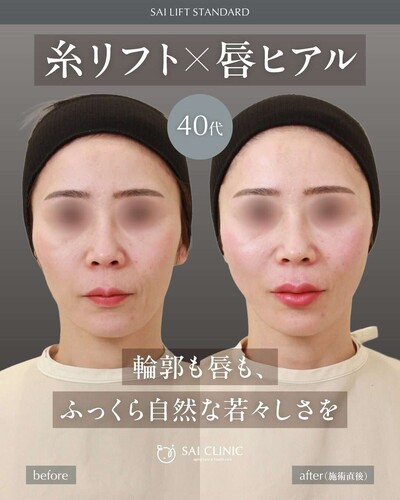SAI LIFT STANDARD と 唇ヒアルロン酸の症例写真