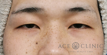 エースクリニックグループの目・二重整形の症例写真[ビフォー]