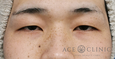 眼瞼挙筋前転法による眼瞼下垂治療の症例写真[ビフォー]
