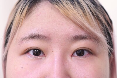 20代　女性　頬、目頭切開　W法　2㎜　当院モニターの症例写真