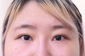 医療法人秀晄会 心斎橋コムロ美容外科クリニックの目・二重整形の症例写真