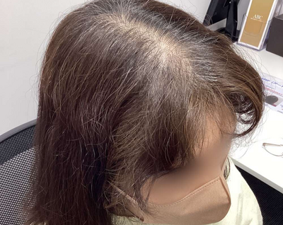 ヘアアートメイク｜60代｜2回の症例写真[ビフォー]