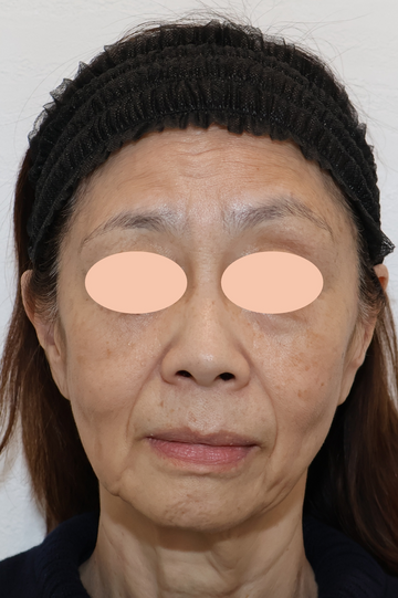 すなおクリニックのしわ・たるみ整形(注入、糸、フェイスリフト)の症例写真[ビフォー]