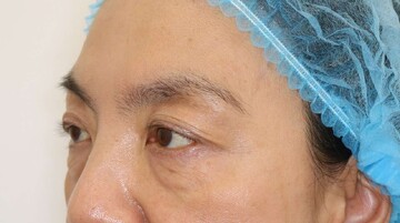 すなおクリニックの目元・クマ・眉下・涙袋整形の症例写真[ビフォー]