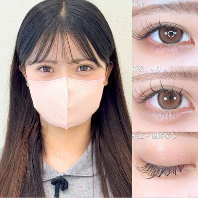 アリエルクイックループダブル二重埋没法/涙袋ヒアルロン酸の症例写真