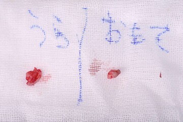 医療法人秀晄会 心斎橋コムロ美容外科クリニックの傷跡治療、ケロイドの症例写真[ビフォー]