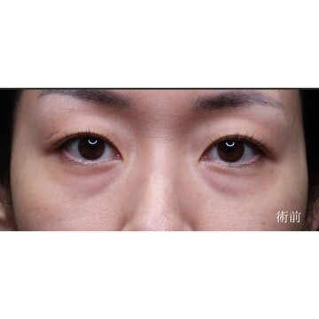 聖心美容クリニックの目元の症例写真[ビフォー]