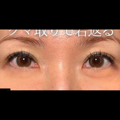 クマ取りで若返り成功🙆🏻‍♀️の症例写真[アフター]