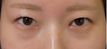 Plume Clinicの二重の症例写真[ビフォー]