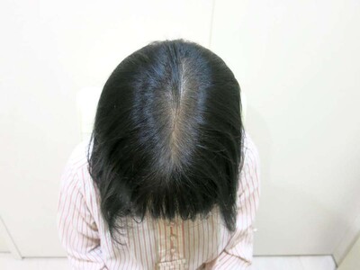 Rebirth+ミノキジェット｜40代｜7か月の症例写真[アフター]