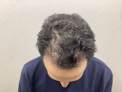 自毛植毛900グラフト｜50代｜3回の症例写真[アフター]