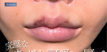 PRISM Beauty Clinicの口元の症例写真[ビフォー]