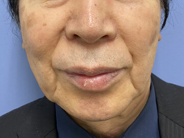 顔のしわ たるみの整形 男性向け の症例写真 画像 メンズ版 美容医療の口コミ広場