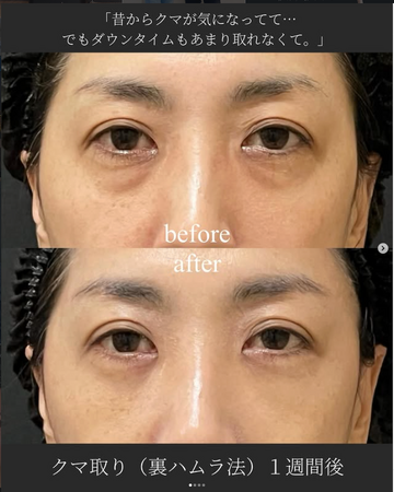 SAI CLINIC （サイクリニック）の目元・クマ・眉下・涙袋整形の症例写真