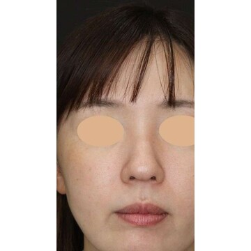 聖心美容クリニックの鼻の症例写真[ビフォー]