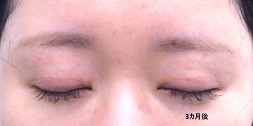 医療法人秀晄会 心斎橋コムロ美容外科クリニックの症例写真[アフター]