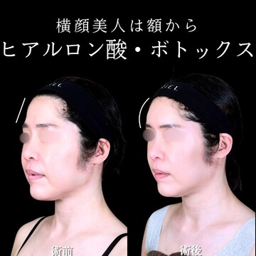 アリエル美容クリニック 大宮院の輪郭・顎・エラ・額・小顔整形の症例写真