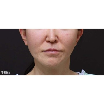 聖心美容クリニックのリフトアップの症例写真[ビフォー]