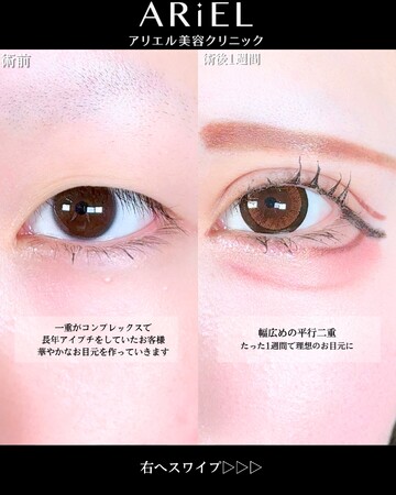 アリエル美容クリニック 大宮院の二重の症例写真
