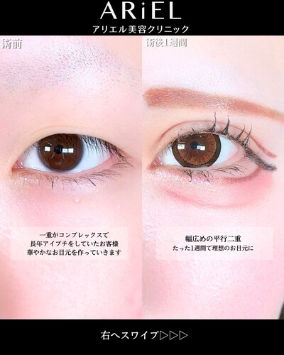 アリエルフォーエバークロス二重埋没法の症例写真